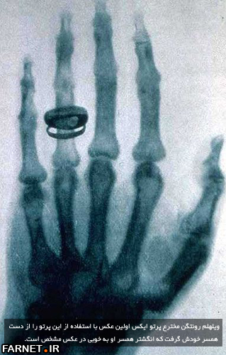 Roentgen-x-ray-von-kollikers-hand